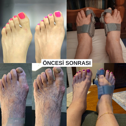 KlinikEvin Başparmak Düzeltici