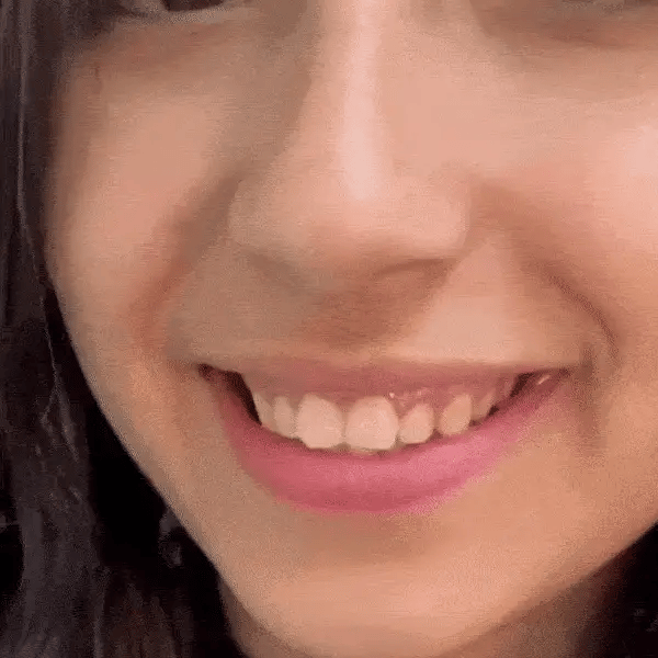 KlinikEvin™ SmileForm Profil Diş Estetik Seti ( Alt Üst Set )