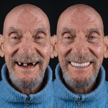 KlinikEvin™ SmileForm Profil Diş Estetik Seti ( Alt Üst Set )