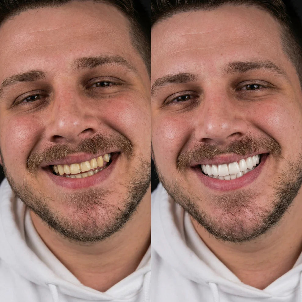 KlinikEvin™ SmileForm Profil Diş Estetik Seti ( Alt Üst Set )
